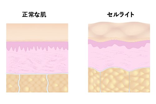 セルライトの形成過程