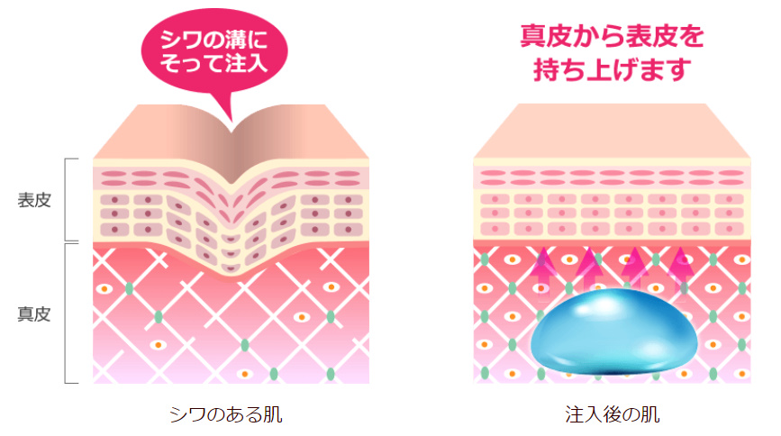 ヒアルロン酸注入